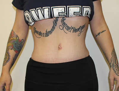 Tummy Tuck before and after - after