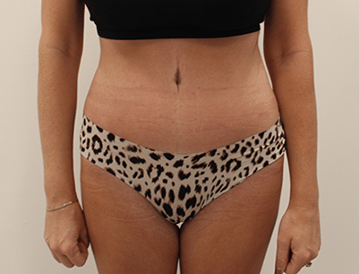 Tummy Tuck before and after - after
