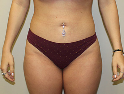 Liposuction before and after - after