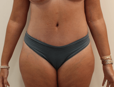 Tummy Tuck before and after - after