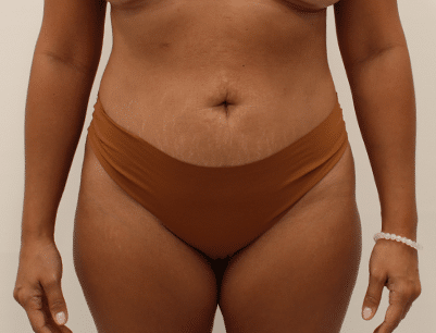 Liposuction before and after - after