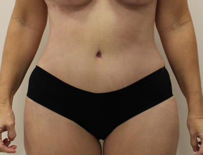 Tummy Tuck before and after - after