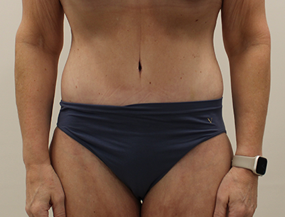 Tummy Tuck before and after - after