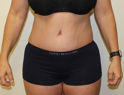 Tummy Tuck before and after - after
