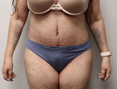 Tummy Tuck before and after - after