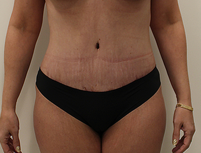 Tummy Tuck before and after - after
