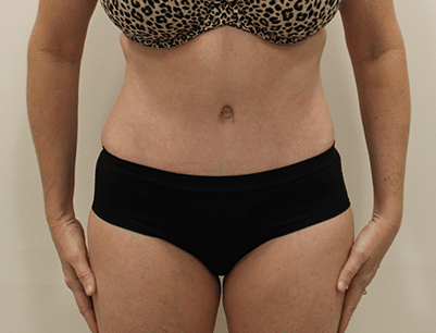 Tummy Tuck before and after - after