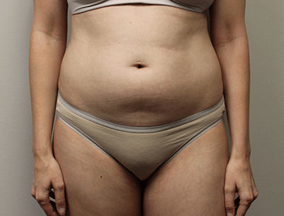 Liposuction before and after - before
