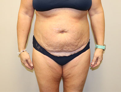Tummy Tuck before and after - before