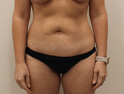 Tummy Tuck before and after - before