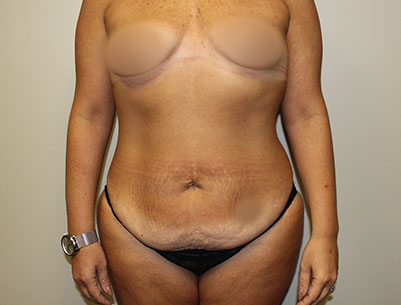 Tummy Tuck before and after - before