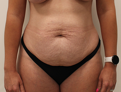 Tummy Tuck before and after - before