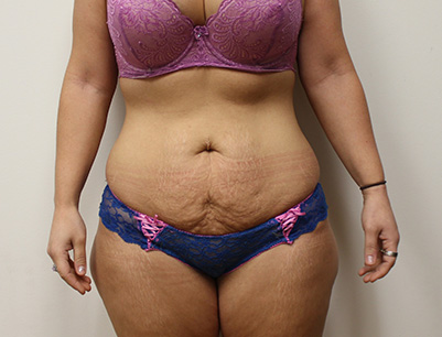 Tummy Tuck before and after - before