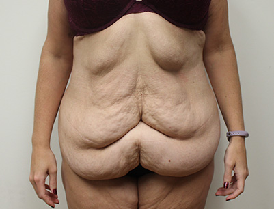 Tummy Tuck before and after - before