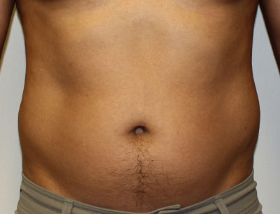 Liposuction before and after - before