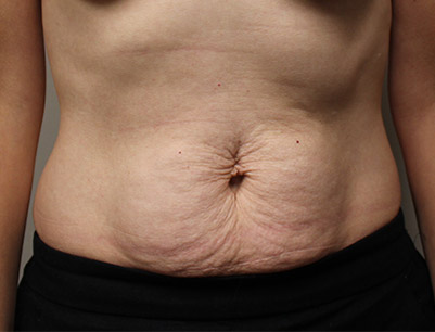 Tummy Tuck before and after - before