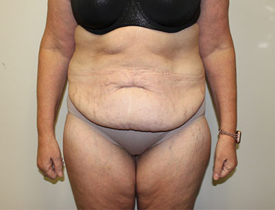 Tummy Tuck before and after - before