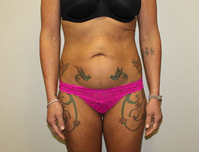 Tummy Tuck before and after - before