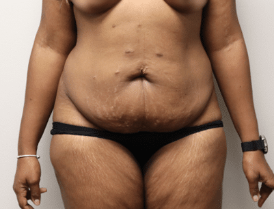 Tummy Tuck before and after - before