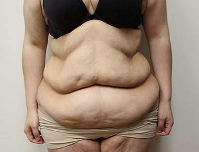 Tummy Tuck before and after - before