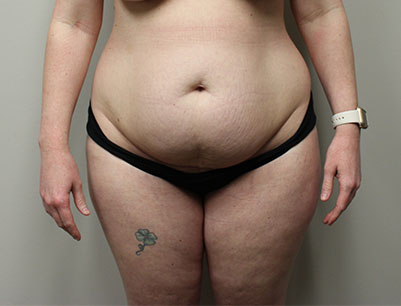 Tummy Tuck before and after - before