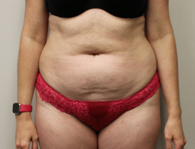 Tummy Tuck before and after - before