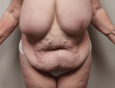 Tummy Tuck before and after - before