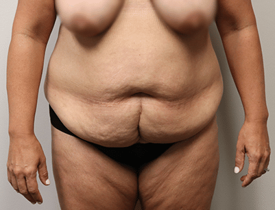 Tummy Tuck before and after - before
