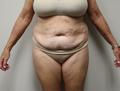 Tummy Tuck before and after - before