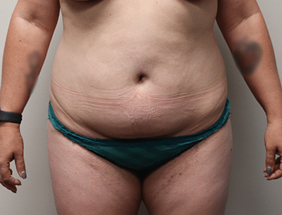 Tummy Tuck before and after - before