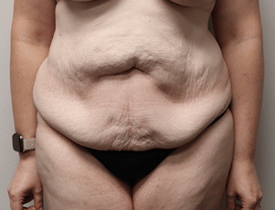 Tummy Tuck before and after - before