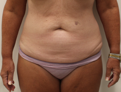 Tummy Tuck before and after - before