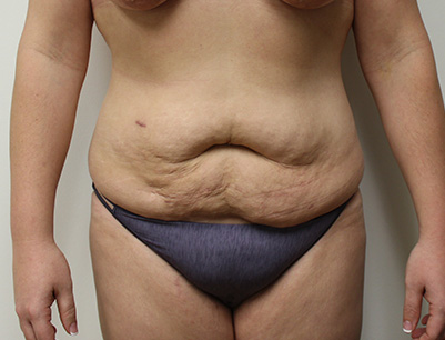 Tummy Tuck before and after - before