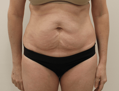 Tummy Tuck before and after - before