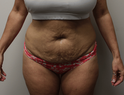 Tummy Tuck before and after - before