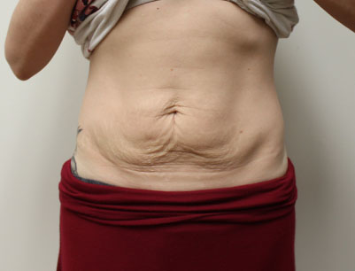 Tummy Tuck before and after - before
