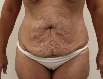 Tummy Tuck before and after - before