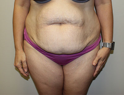 Tummy Tuck before and after - before