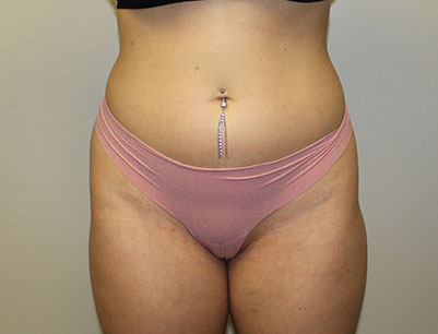 Liposuction before and after - before