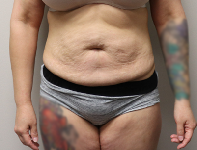 Tummy Tuck before and after - before
