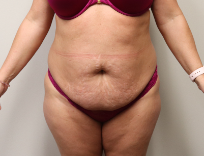 Tummy Tuck before and after - before