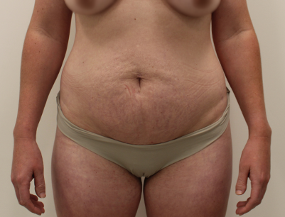 Tummy Tuck before and after - before