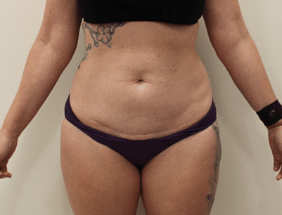 Tummy Tuck before and after - before