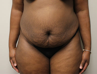 Tummy Tuck before and after - before