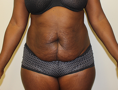 Tummy Tuck before and after - before
