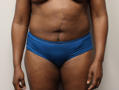 Liposuction before and after - before
