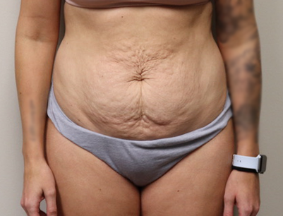Tummy Tuck before and after - before