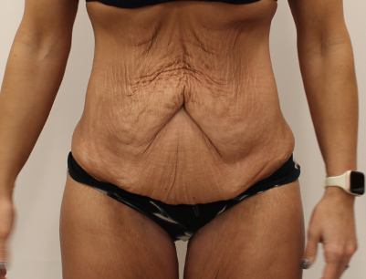 Tummy Tuck before and after - before