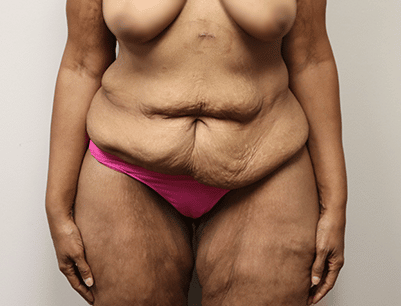 Tummy Tuck before and after - before