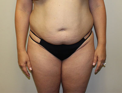 Tummy Tuck before and after - before
